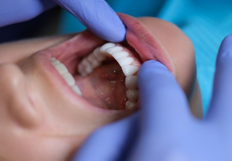 oral cancer checkup