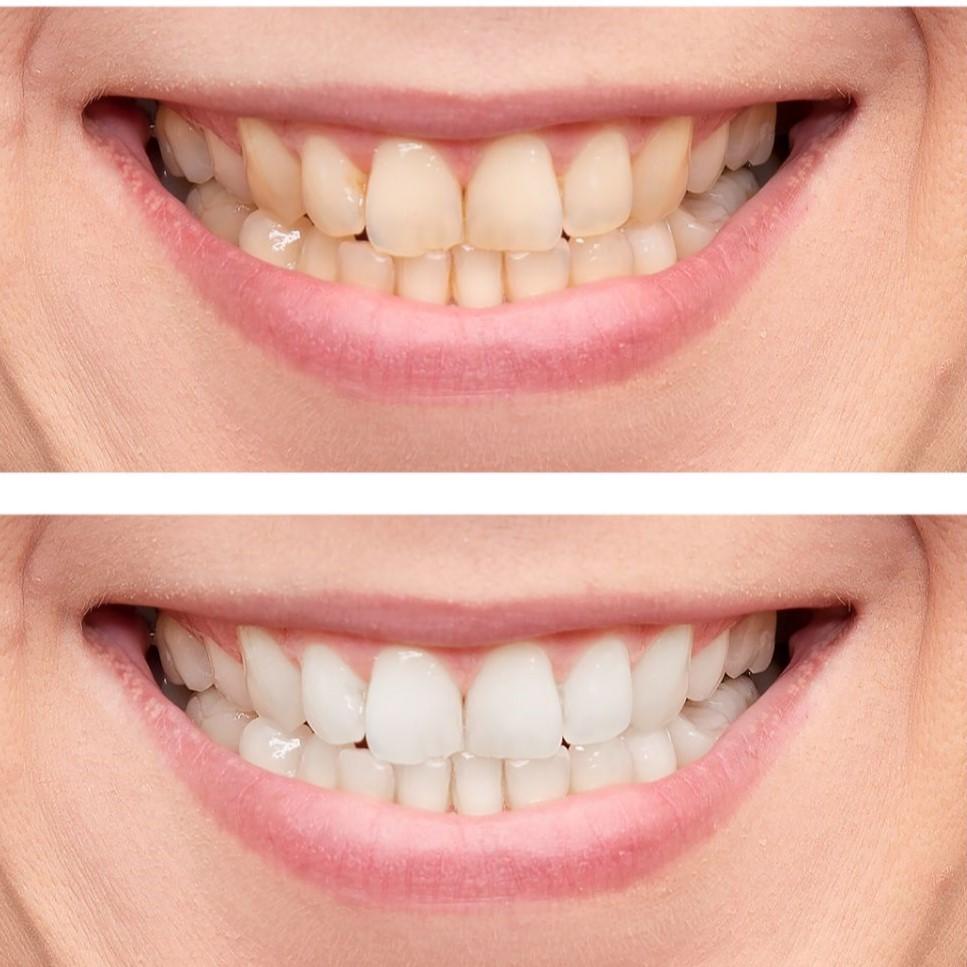 Before/after image of teeth whitening