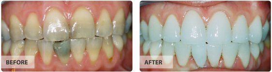 Full Mouth Cosmetic Dentistry