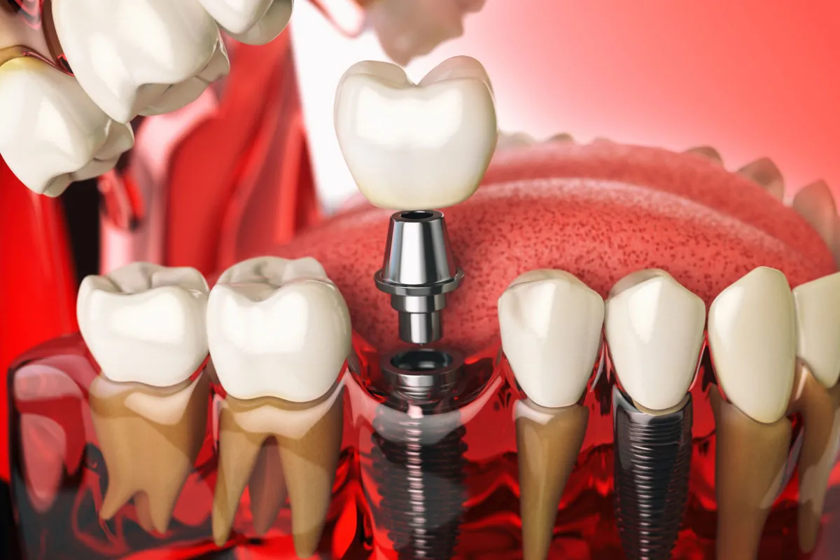 3D model showing a dental implant being placed