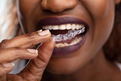 woman putting in her Invisalign clear aligners