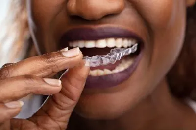 woman putting in her Invisalign clear aligners